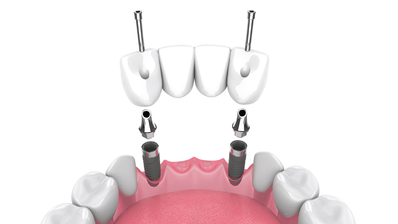 Fixed Implant Bridge