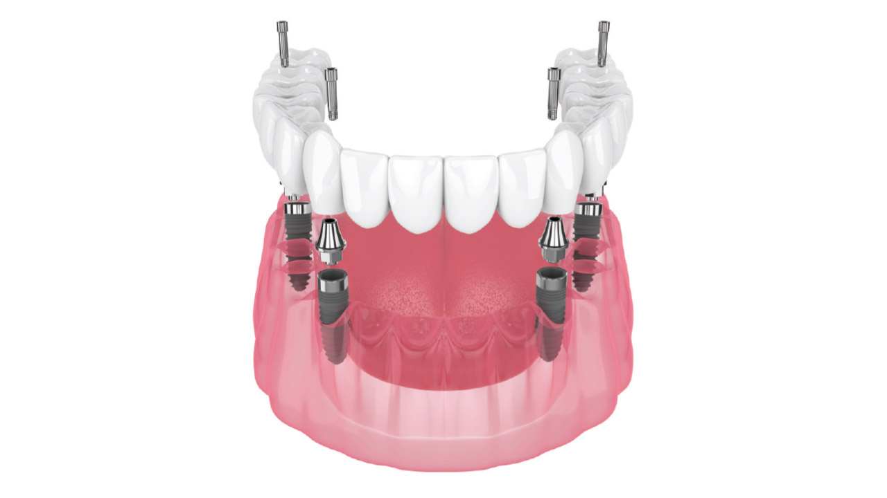 Hybrid Denture